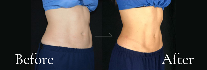 スターフォーマー®プロ治療 ビフォーアフター