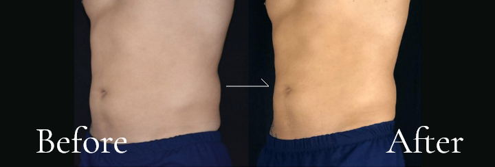 インティマウェーブ®治療 ビフォーアフター